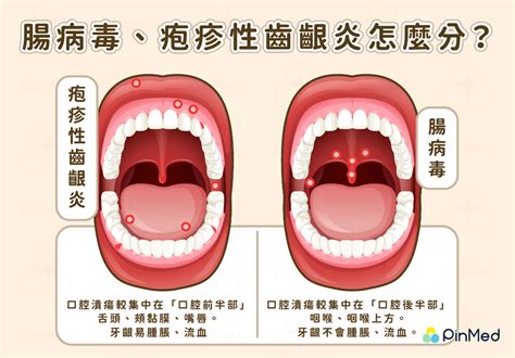 喉嚨長一顆痘痘|喉嚨長痘痘：休息、避免刺激、止痛、戒菸戒酒